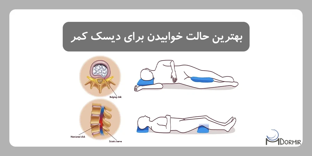 عکس درست خوابیدن برای دیسک کمر